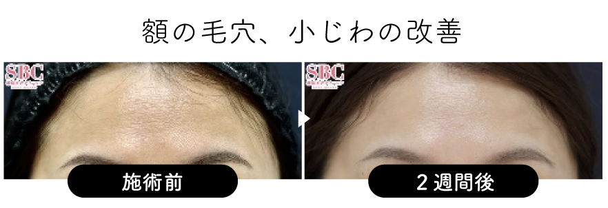 額の毛穴、小じわの改善