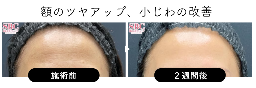 額のツヤアップ、小じわの改善