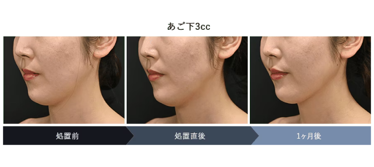 脂肪溶解注射