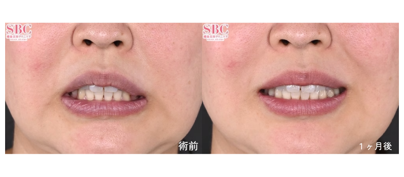 SBCトキシルスレッド