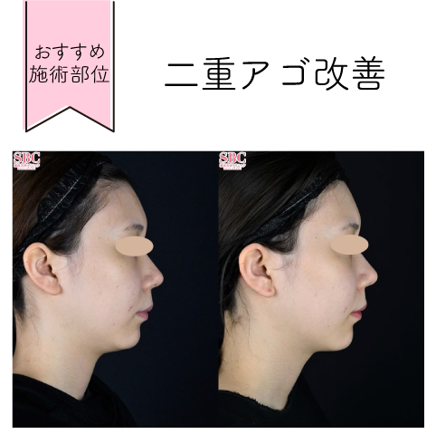 おすすめの施術部位