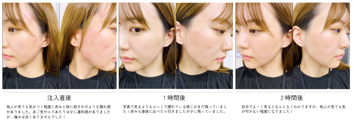 注入後のダウンタイム