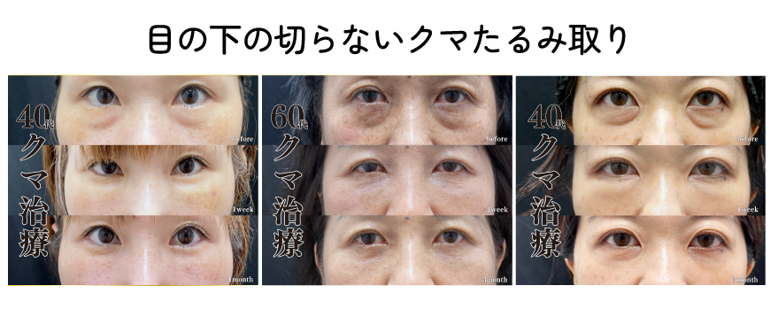 目の下の切らないクマたるみ取り