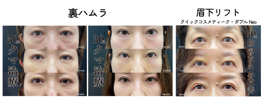 裏ハムラ・眉下リフト