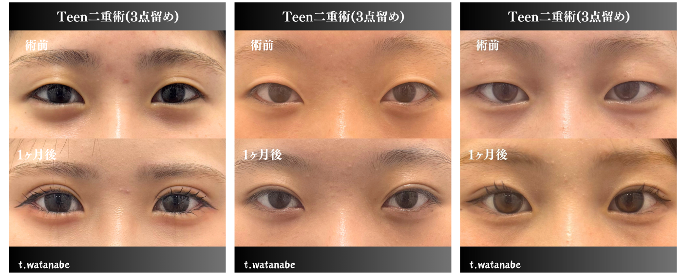 teen二重術