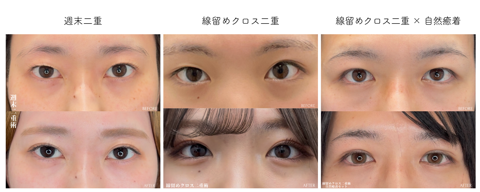 目元にあった二重術を