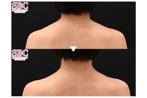 肩の華奢見せ、肩こり改善に