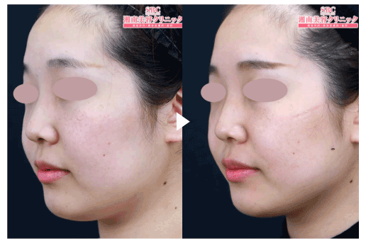 ウルトラリフトプラスHIFU