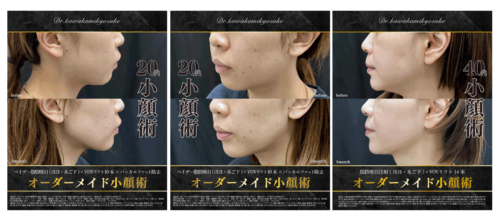 根こそぎとれるVASER脂肪吸引