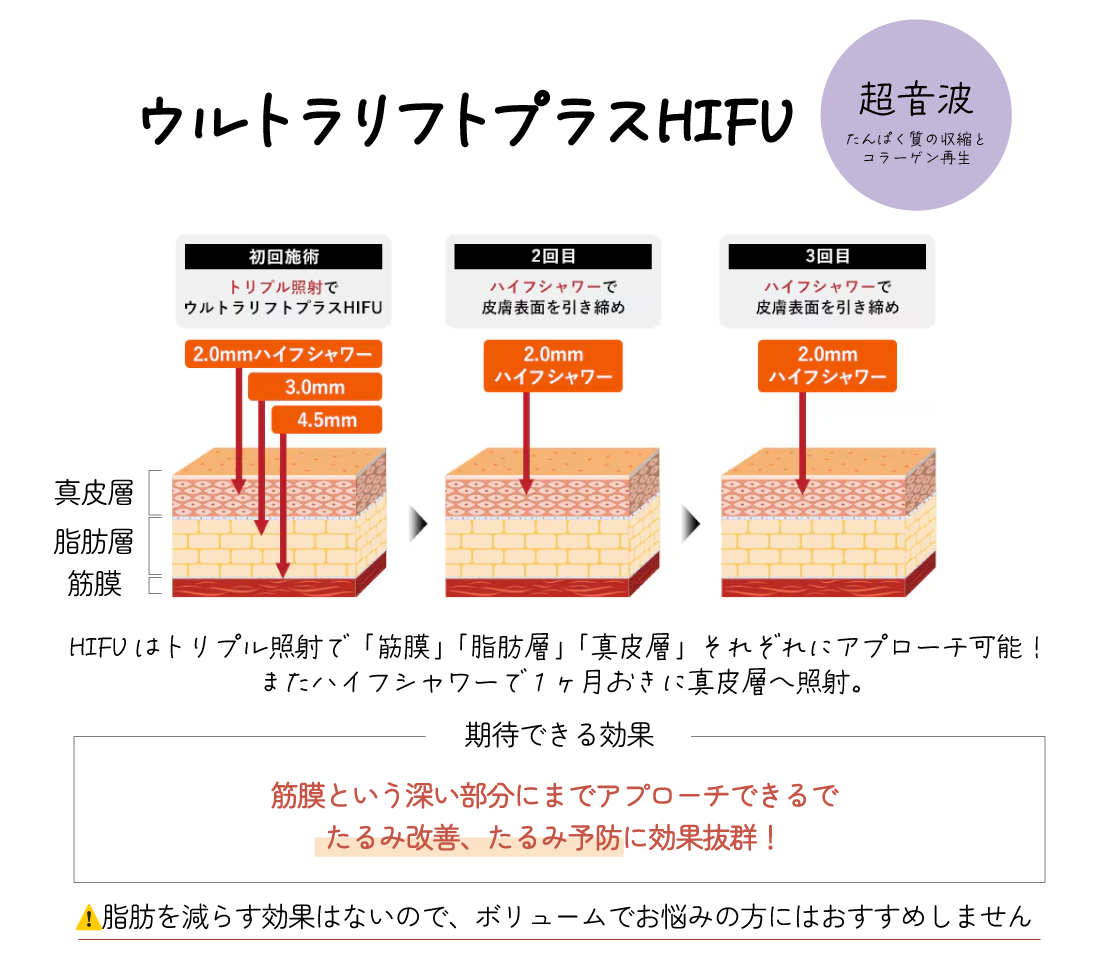『ウルトラリフトプラスHIFU』がおすすめ