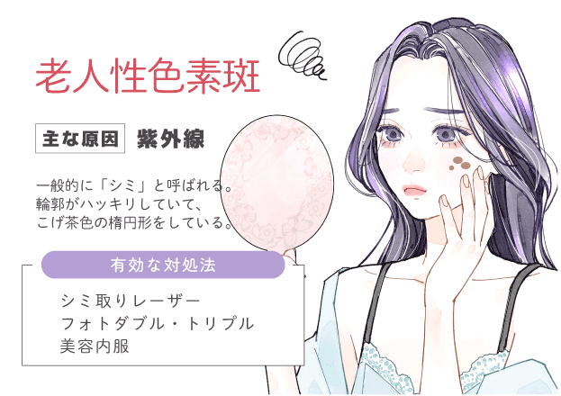 老人性色素斑（シミ）
