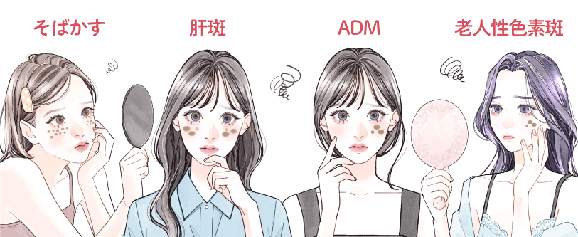 シミ？肝斑？そばかす？ADM？