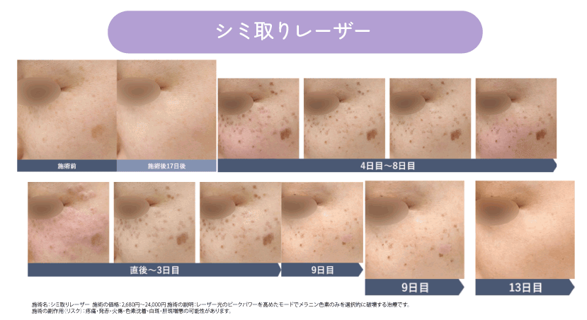 宇都宮で出来るシミ取り治療