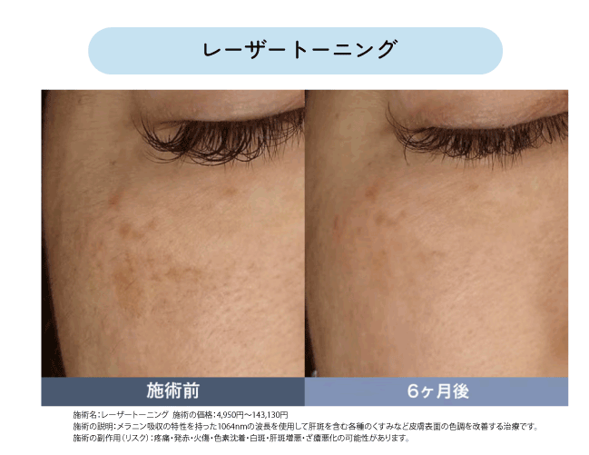 宇都宮で出来る肝斑治療