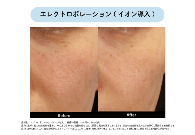 エレクトロポレーション(イオン導入)