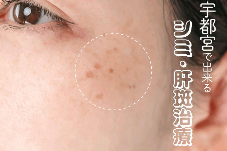 症状にあったシミ・肝斑の治療！宇都宮でシミ取りするなら湘南美容クリニック宇都宮院