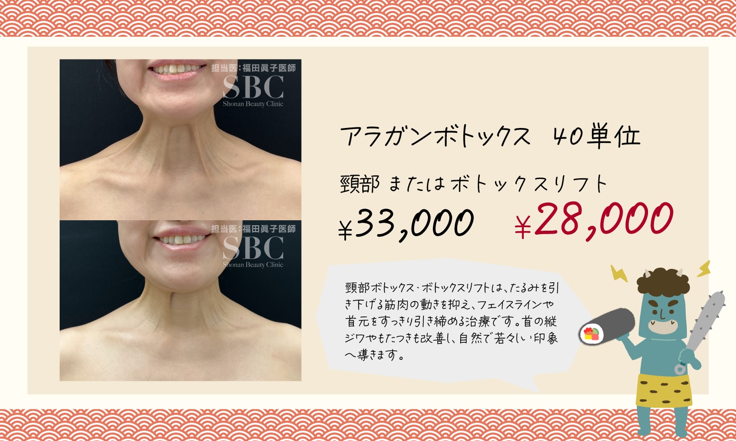 頸部ボトックス・ボトックスリフト