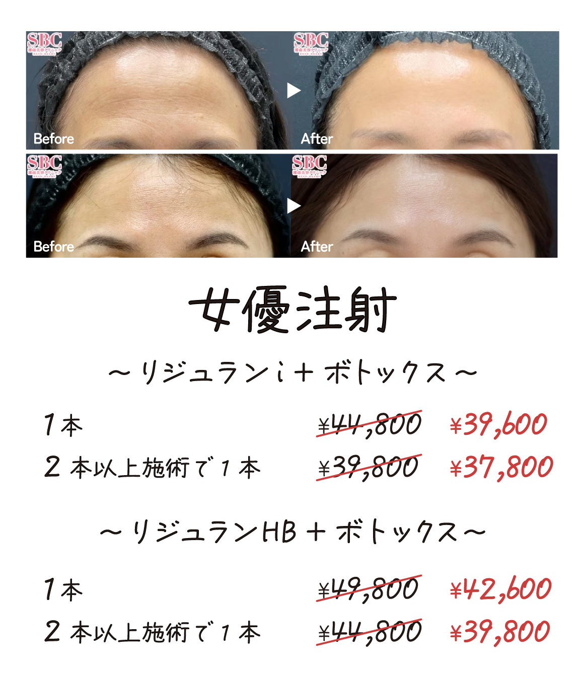 女優注射　<br />
リジュランi＋ボトックス or リジュランHB＋ボトックス