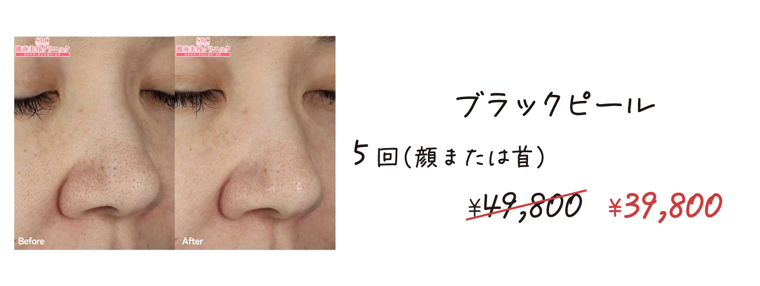 ブラックピール