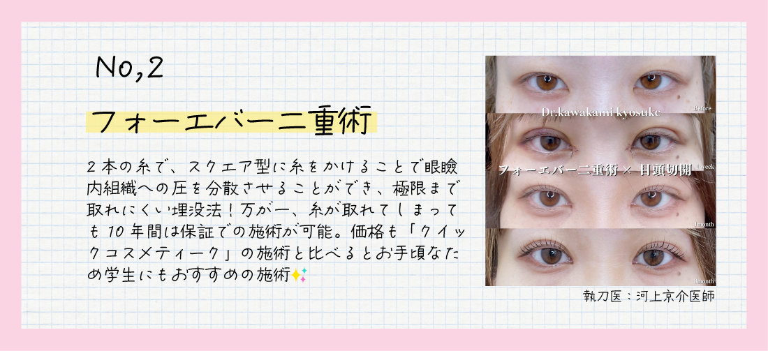 『フォーエバー二重術』