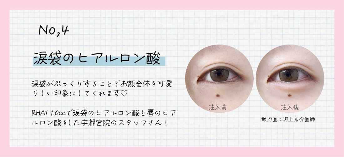 涙袋のヒアルロン酸