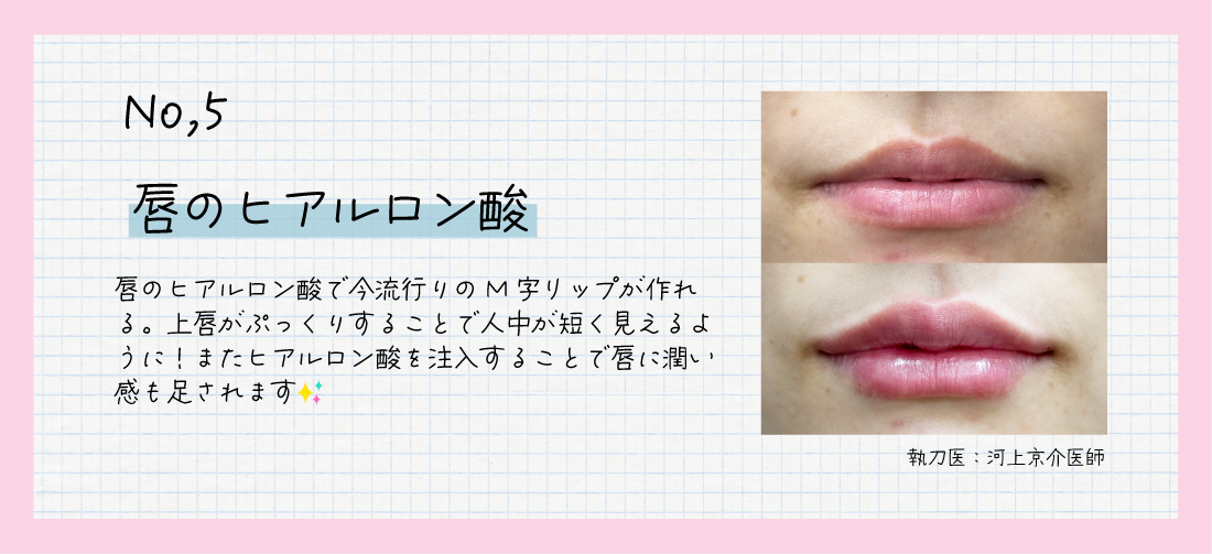 『唇のヒアルロン酸』