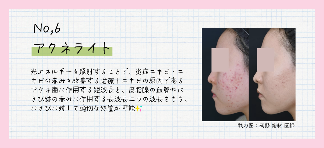 『アクネライト』