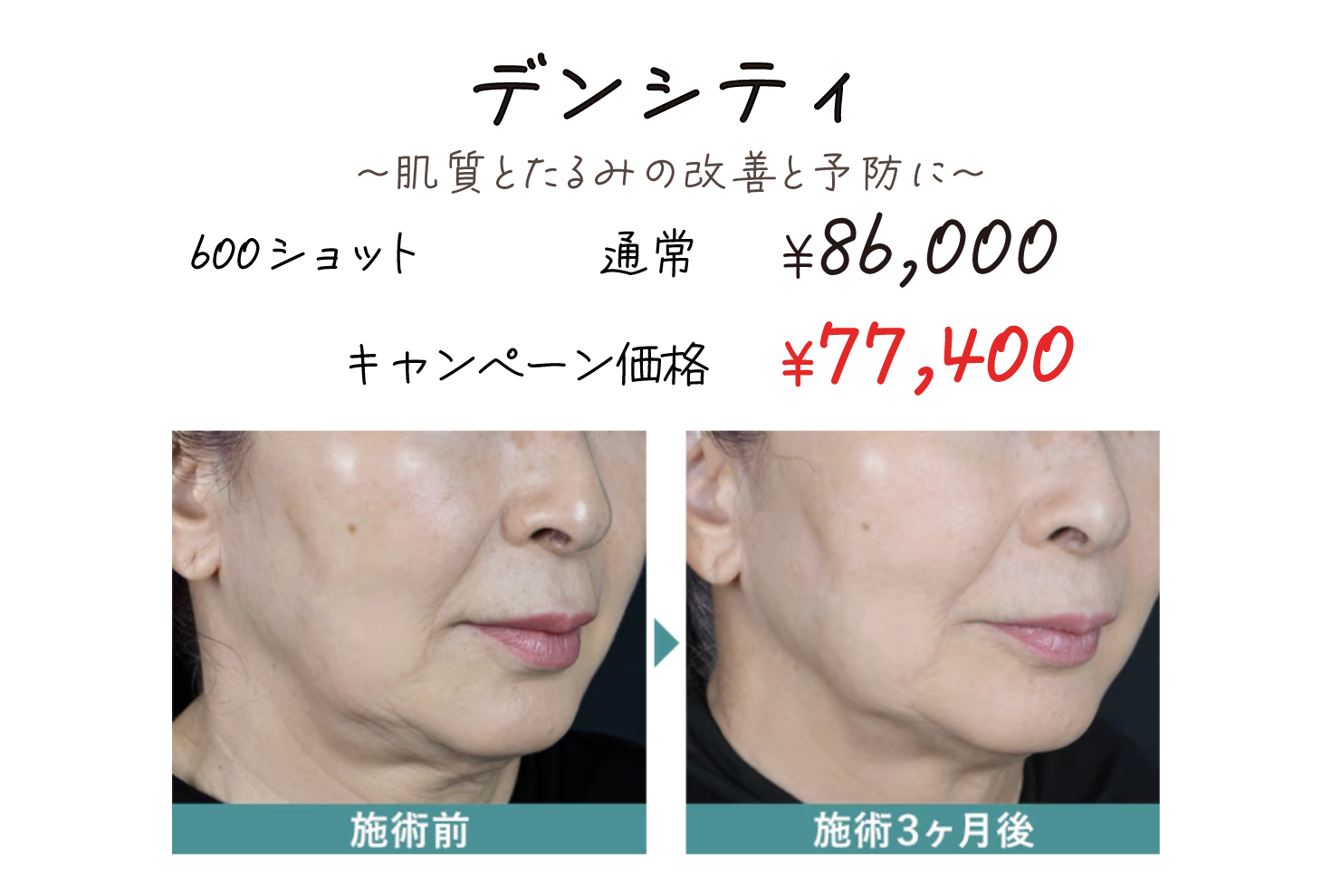 肌質改善とたるみの改善と予防に