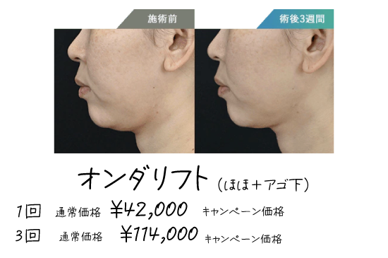 脂肪細胞を減らす