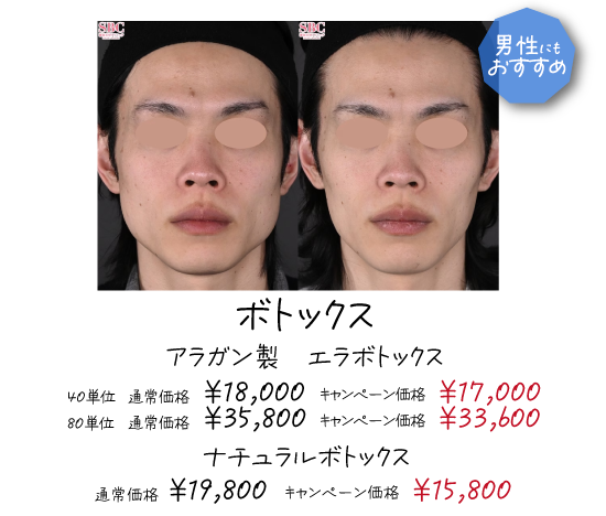 エラ張り改善