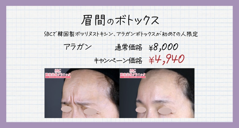 眉間のボトックス