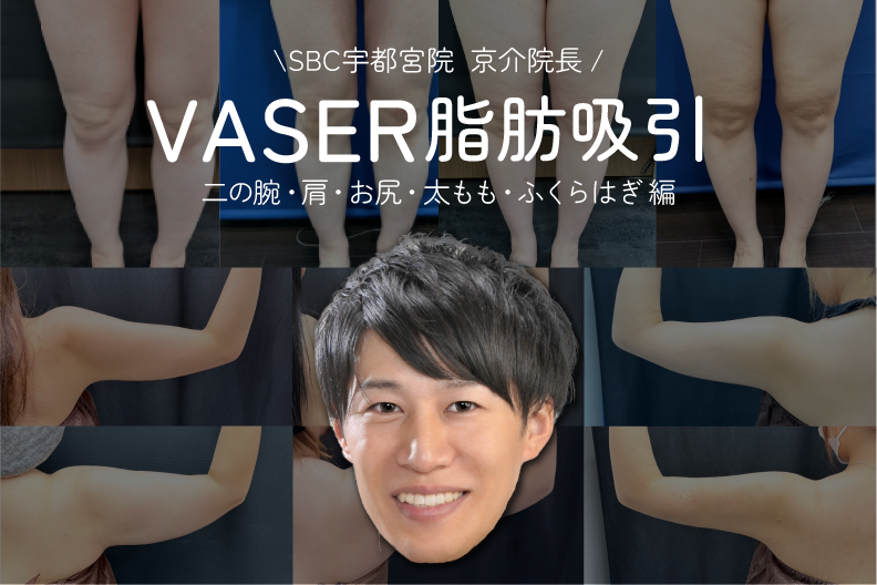 「ダイエットでは変わらなかった脂肪に。」京介院長による脂肪吸引|湘南美容クリニック宇都宮院
