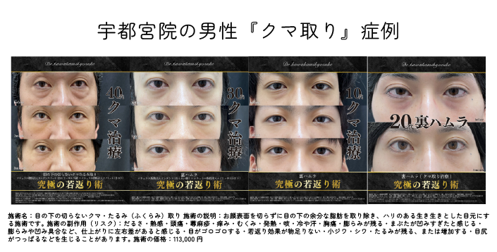 目の下の切らないクマたるみ取り