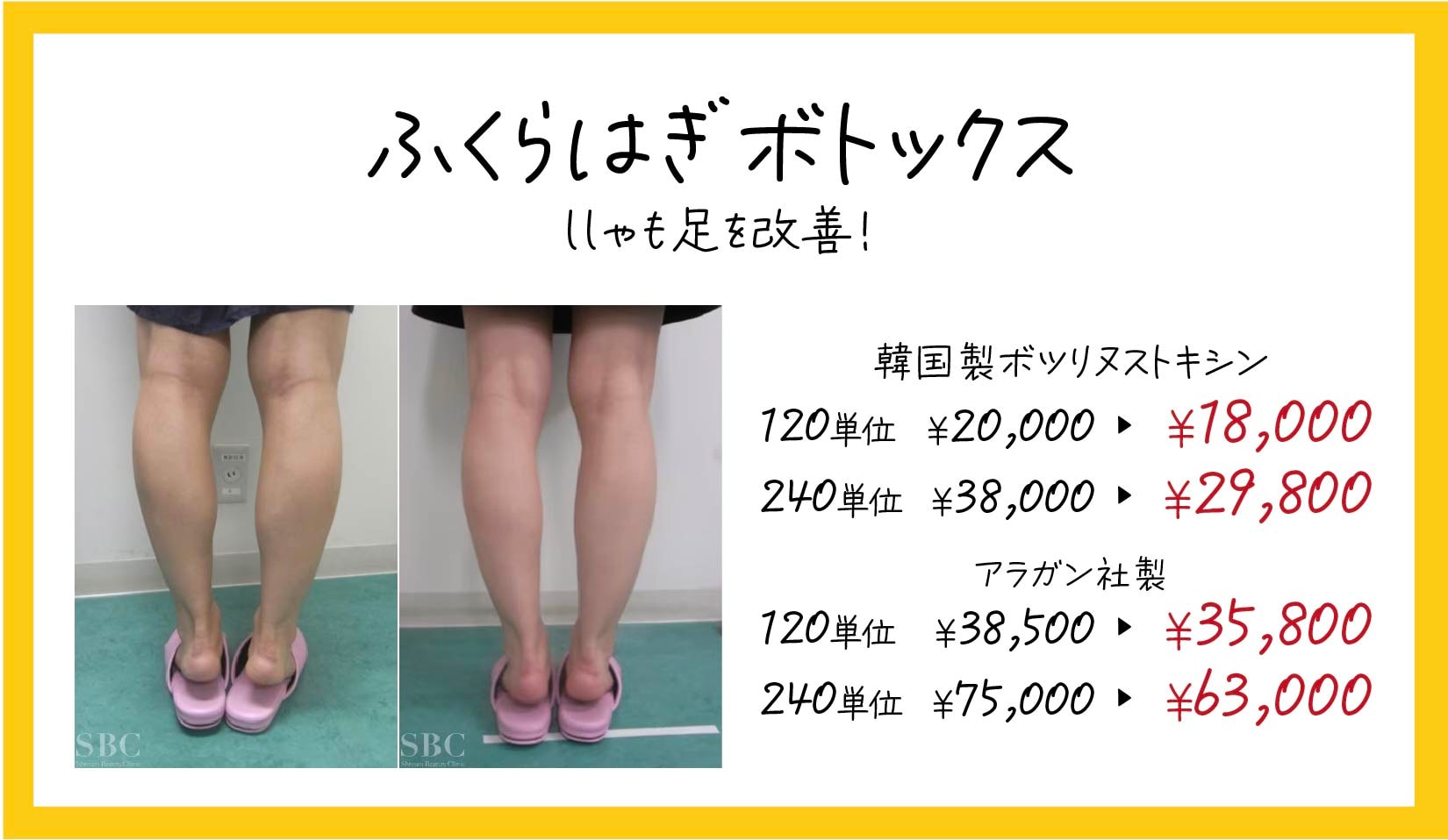 ボトックスでふくらはぎの筋肉を減少