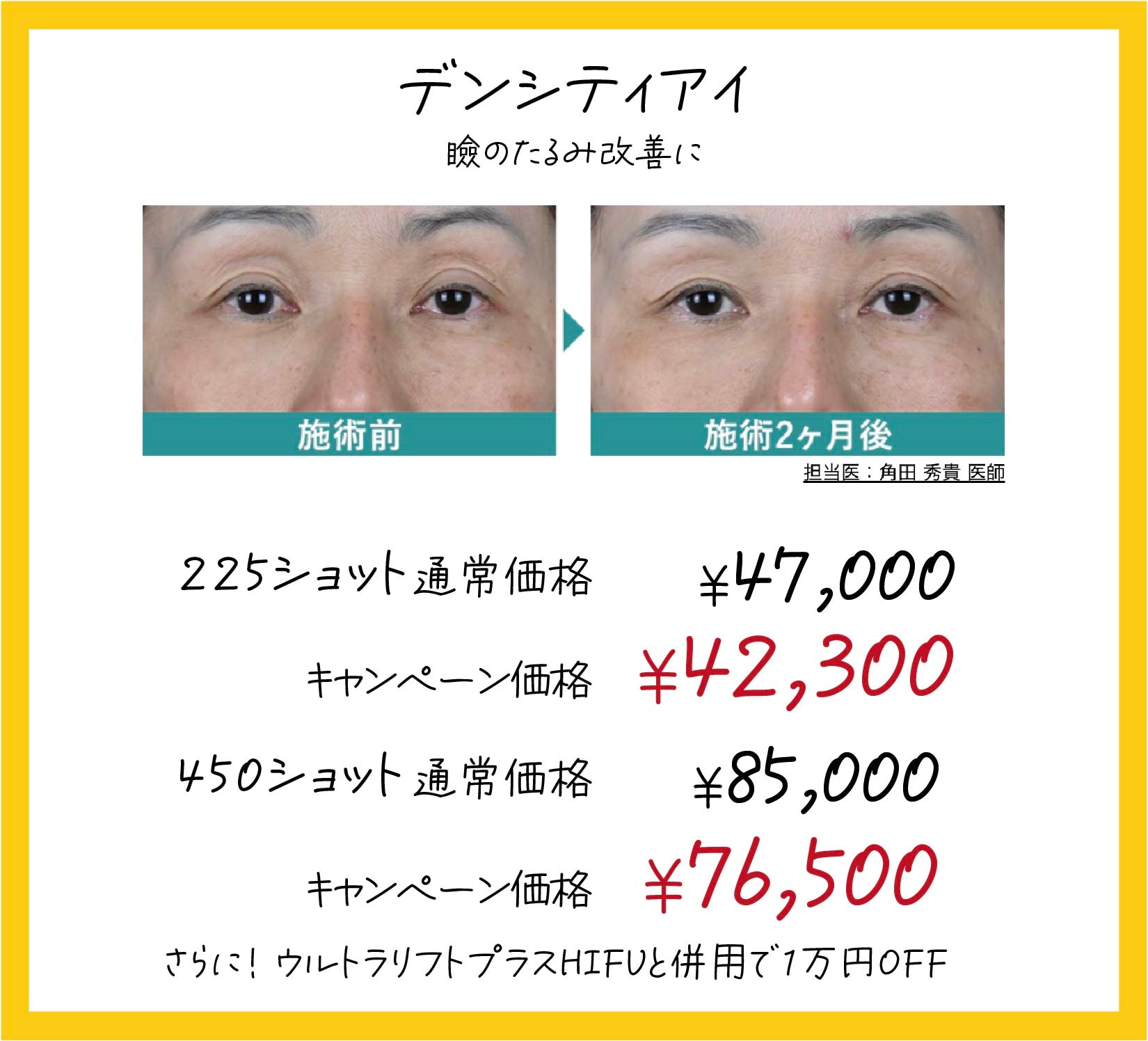 レーザー治療でできる目元のたるみ改善