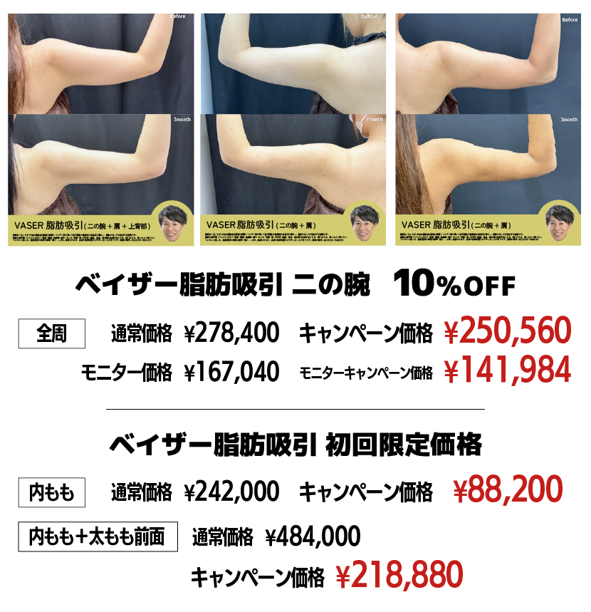 ベイザー脂肪吸引 初回限定価格登場