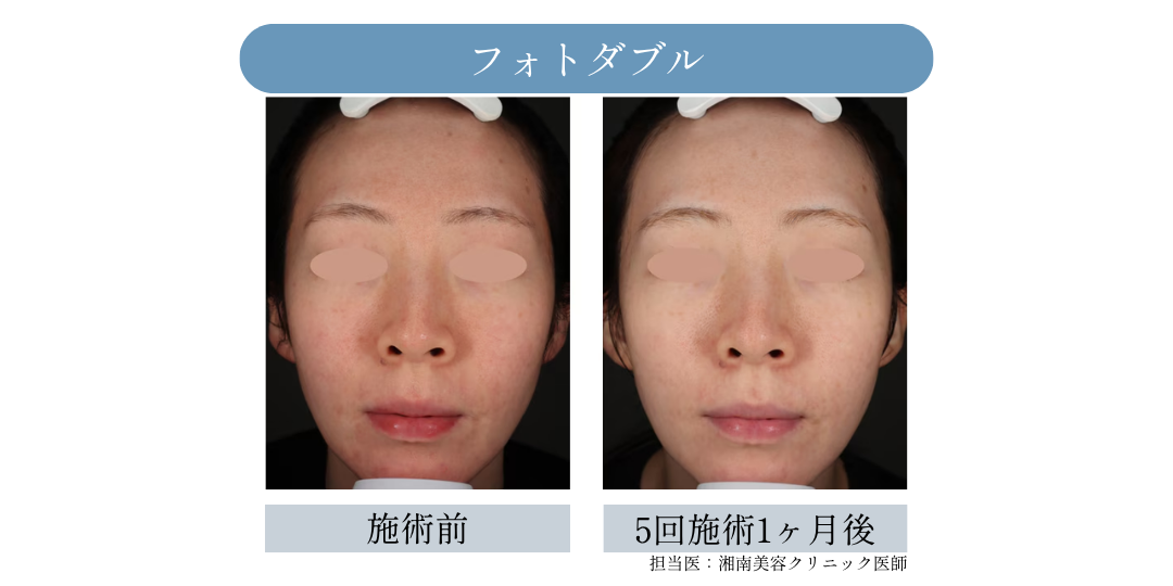IPL治療（フォトダブル・フォトトリプル）