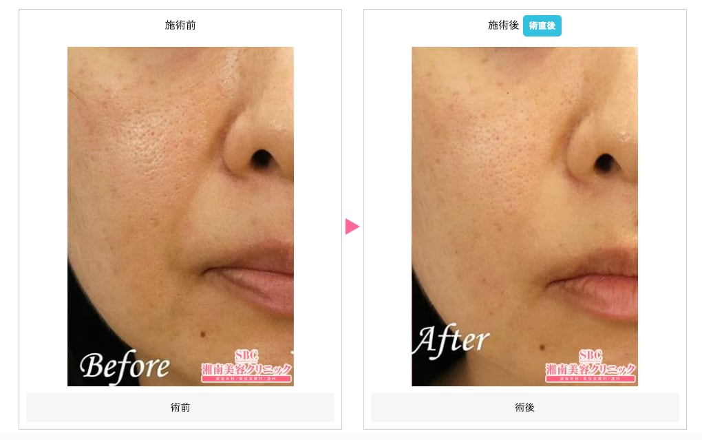 頬（ほうれい線）