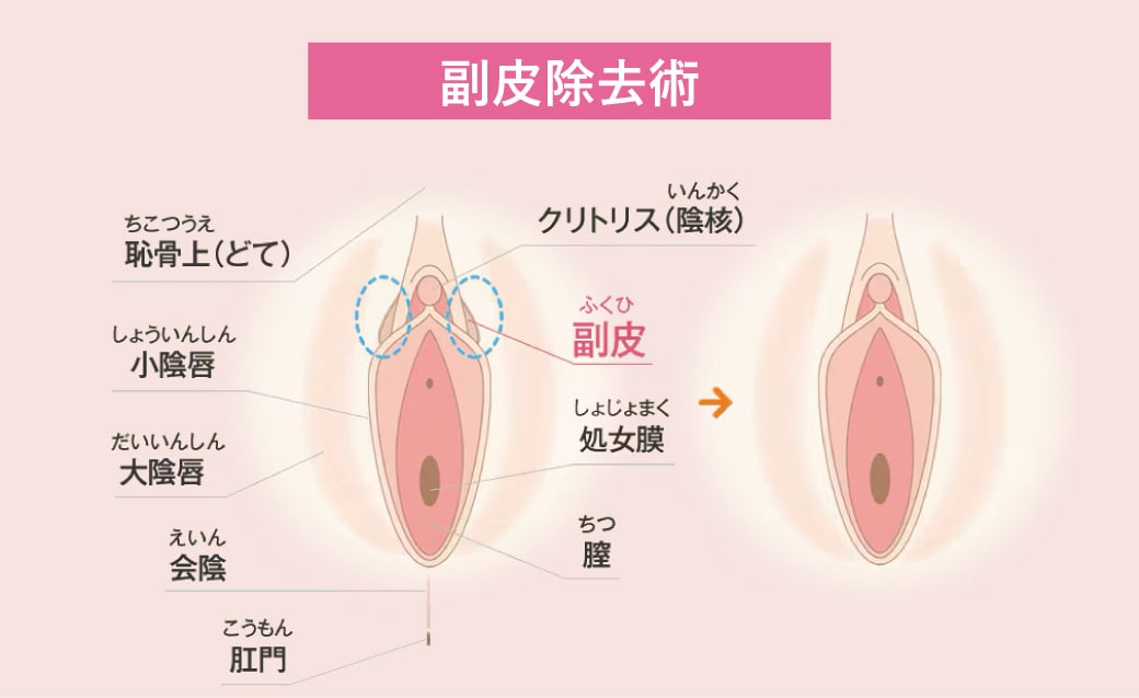 副皮除去術（抜糸あり／なし）