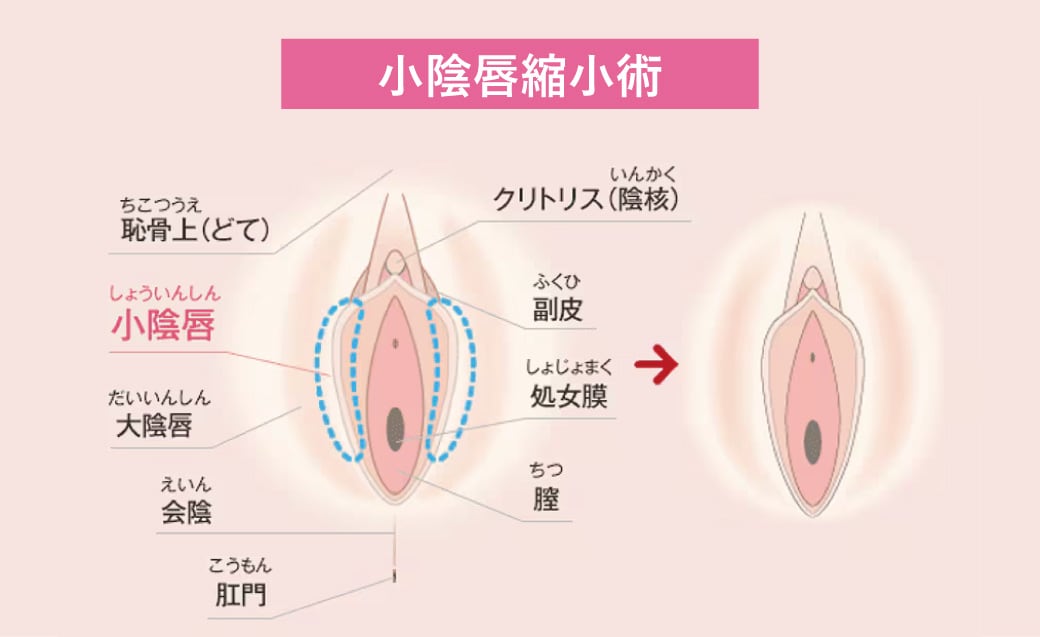 小陰唇縮小術（抜糸あり／なし）