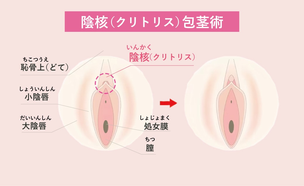 陰核包茎術（抜糸あり／なし）