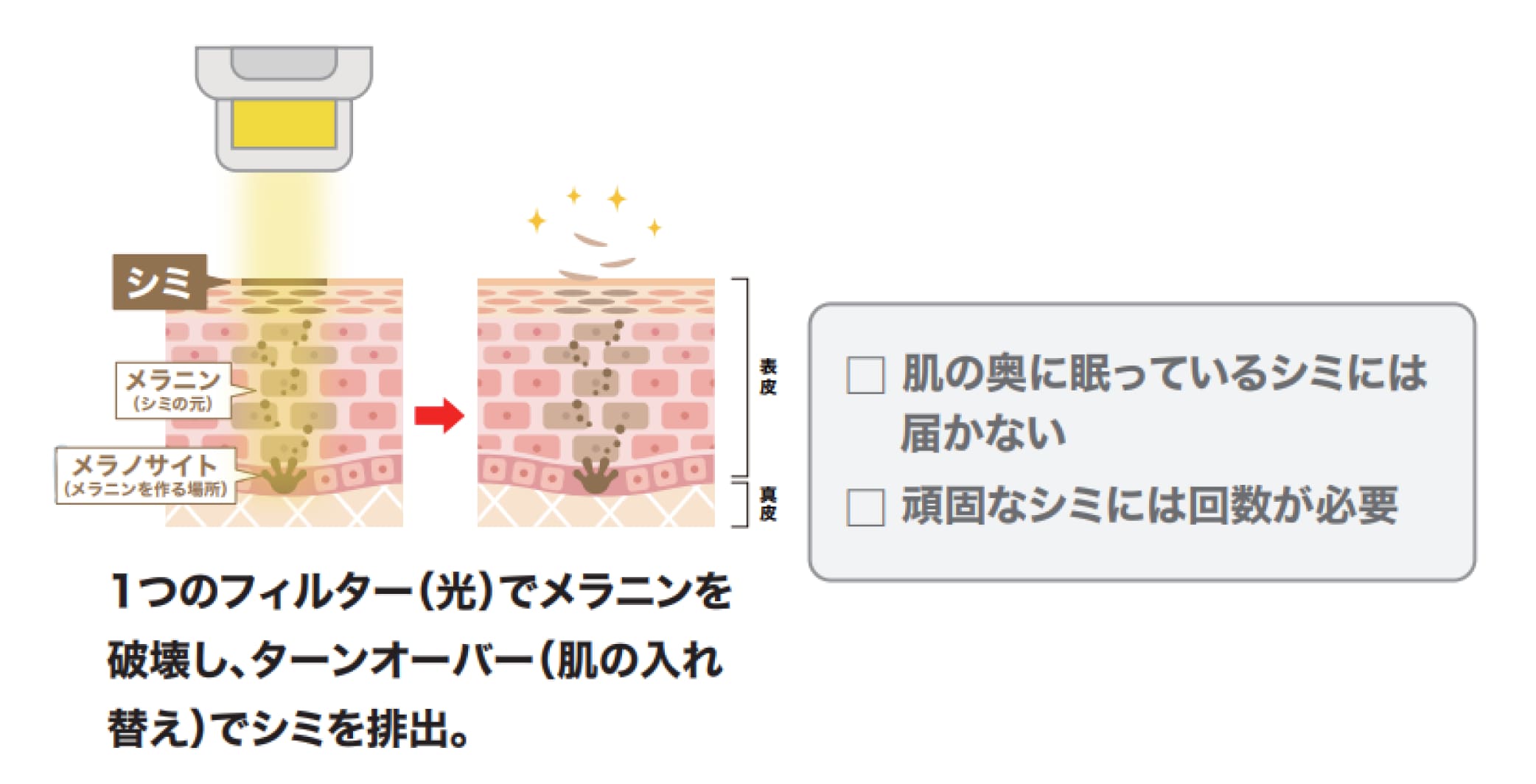 従来のIPLは「ほぼ同じ設定で全顔照射」