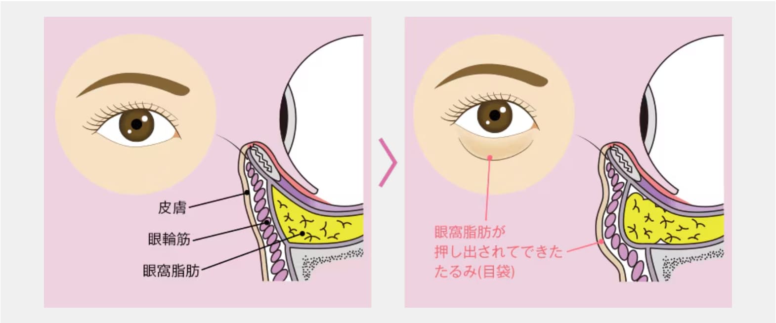 目の下のクマ・たるみ（ふくらみ）の主な原因は、「目袋3脂肪」