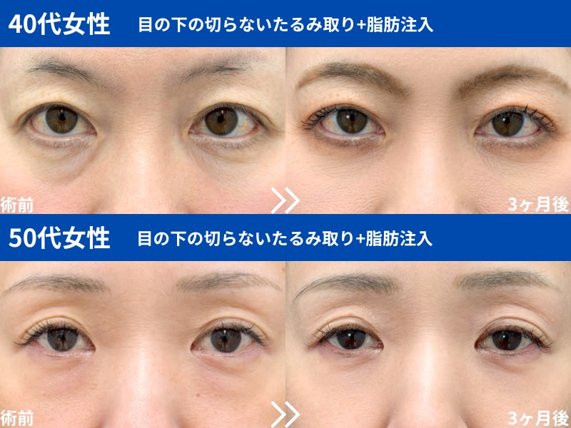 目の下の切らないクマ取り・たるみ取り
