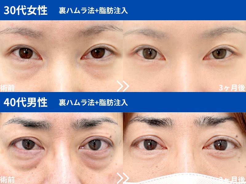 裏ハムラ法