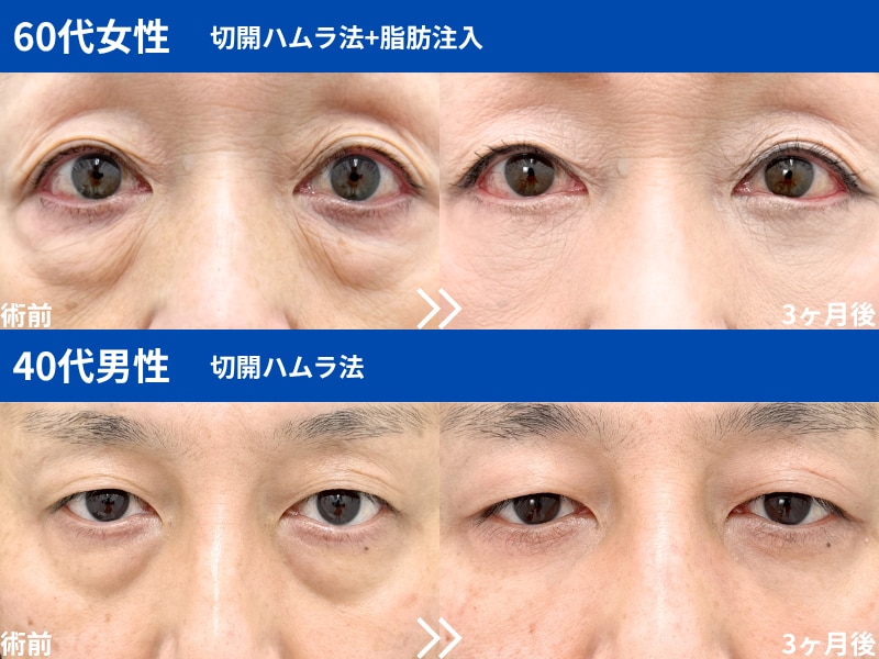 切開ハムラ法