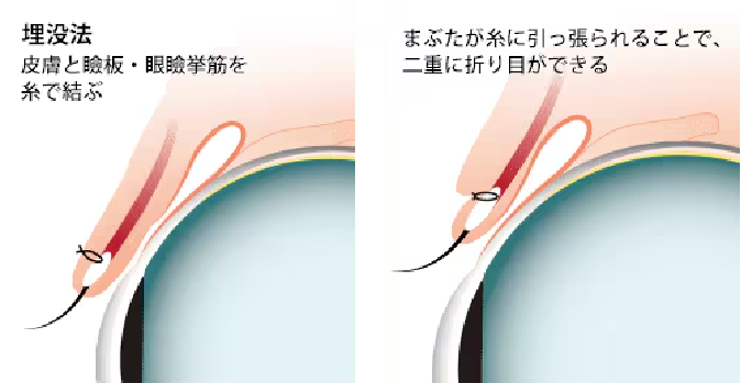 \初心者ならまずはこれ!/埋没法