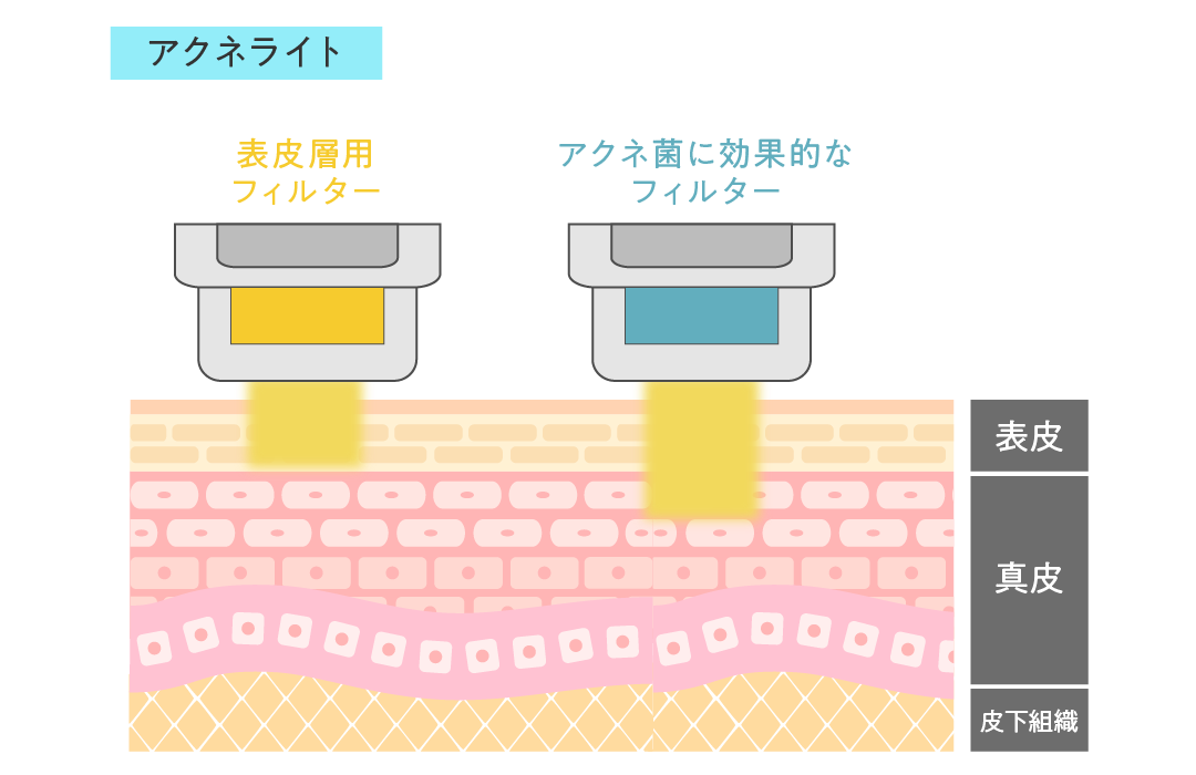 アクネライト