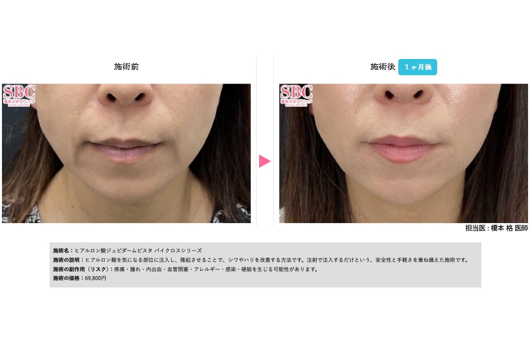 ジュビダーム ボリフト|ほうれい線改善に効果的なヒアルロン酸
