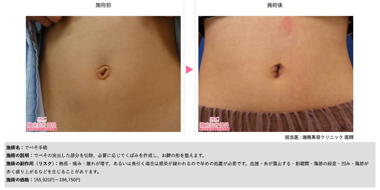でべそ手術